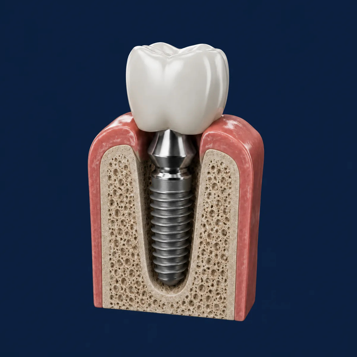 Implantes Dentários